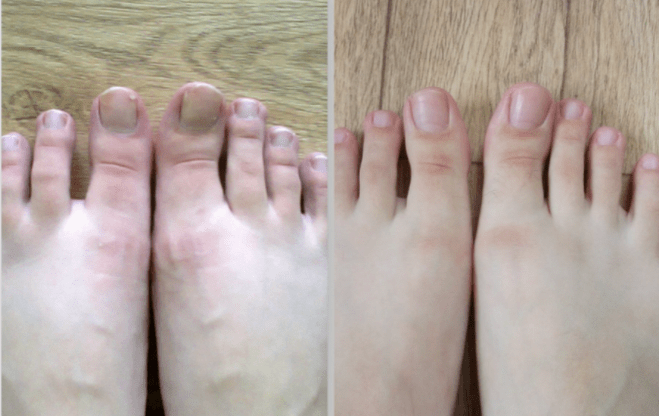 antes e depois do tratamento para fungos nas unhas