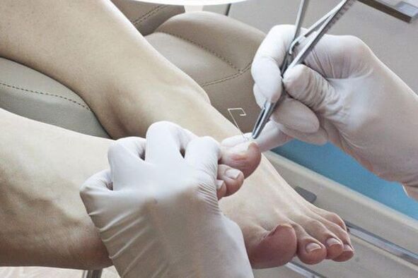 tratamento de fungos nas unhas por um médico