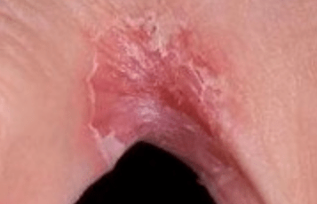 Fungo nas pernas entre os dedos