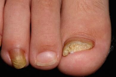 Melose de unhas nas pernas