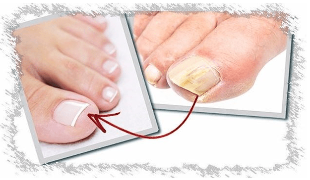 Causas de fungo das unhas