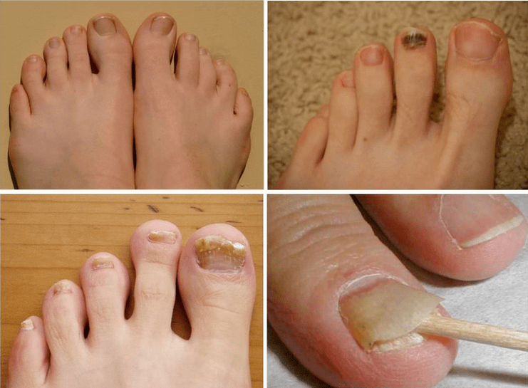 Sinais de fungo das unhas