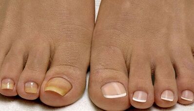 As causas da aparência do fungo nas unhas