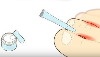 como tratar fungos nos dedos dos pés