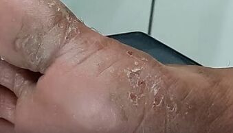 tipos e formas de fungos nos dedos dos pés