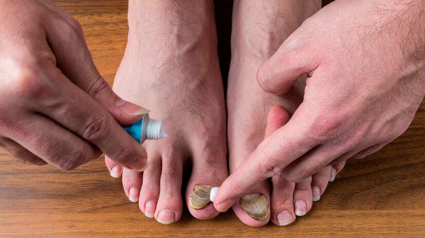 Aplicação de creme antifúngico nas unhas dos pés para tratar onicomicose